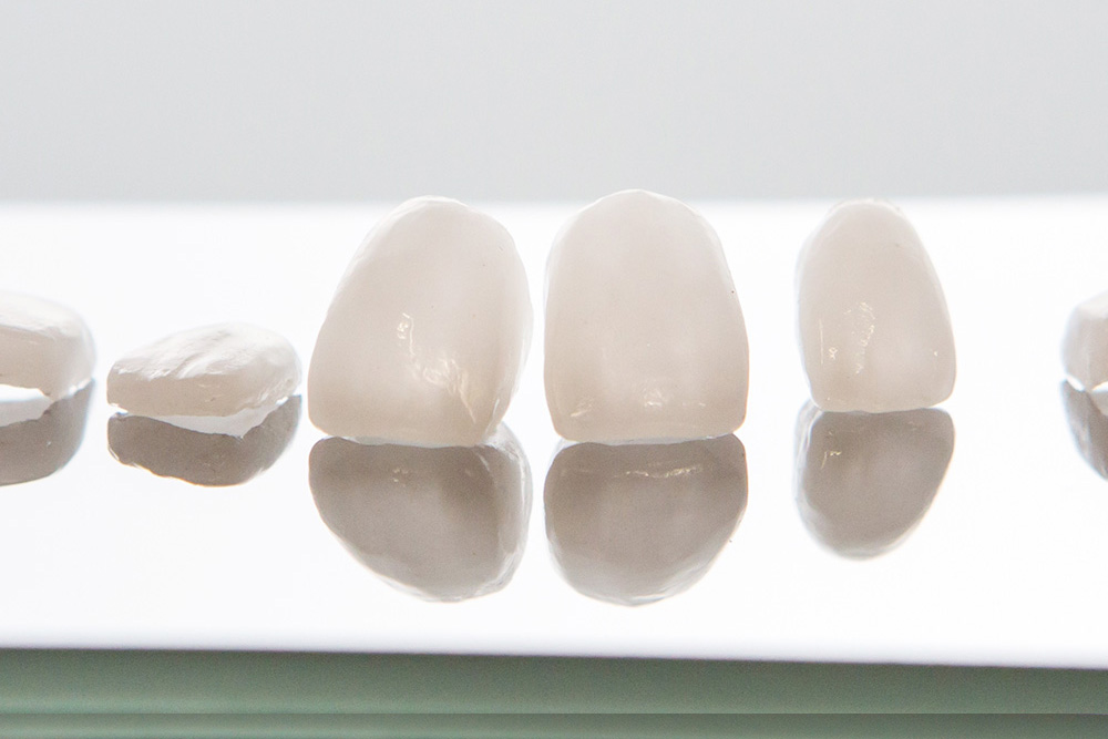 ceramic veneers