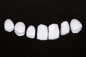 white ceramic veneers 2021 08 30 03 10 35 utc