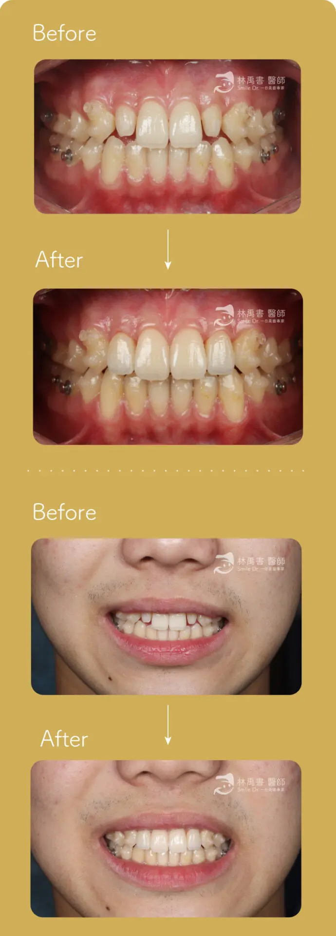 前牙貼片-兩顆貼片 2 兩顆貼片 內圖1 m