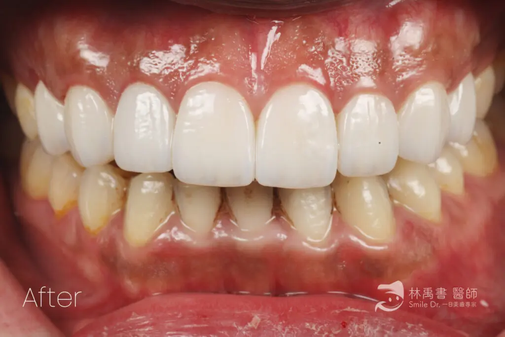 前牙貼片-希露弟弟啃雞腿 2 veneercase geitwei after1