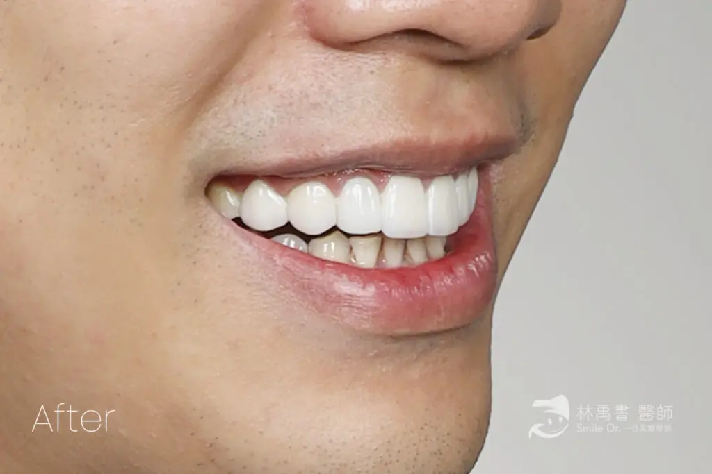 前牙貼片-希露弟弟啃雞腿 6 veneercase geitwei after3