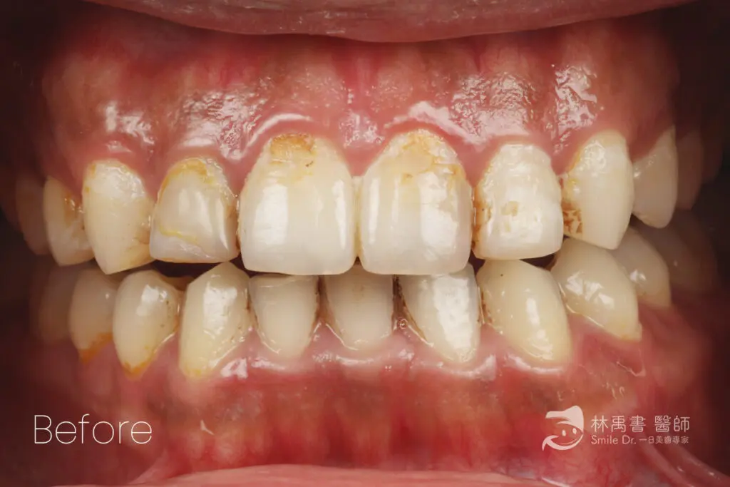 前牙貼片-希露弟弟啃雞腿 1 veneercase geitwei before1