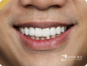 首頁 15 veneercase geitwei small